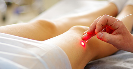 Vein Treatment Options