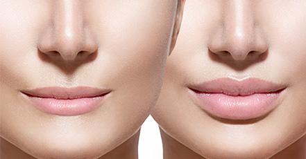 Before and after results of Juvederm usage