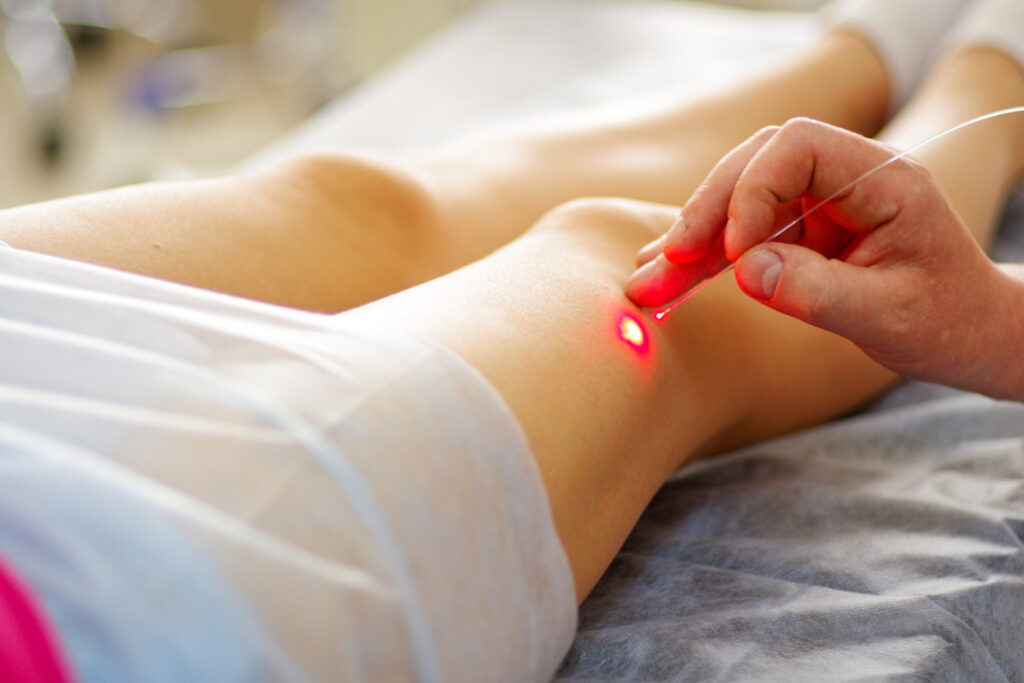 Discover the latest advances in laser therapy for vein treatment, offering minimally invasive solutions with improved outcomes.