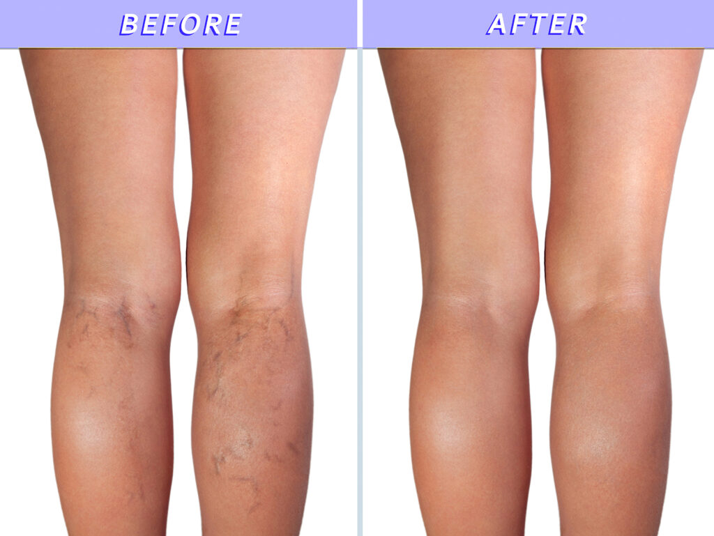 Image of legs with spider veins and after the treatment clean legs - Dietary Supplement for Healthy Veins