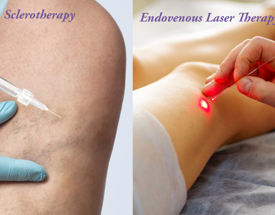 image showing both a sclerotherapy procedure and an EVLT procedure side-by-side, highlighting the differences in techniques and equipment.